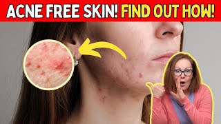 How to Get Rid of Acne: 4 Powerful Tips for CLEAR SKIN! 🔴DON'T MISS THE LAST TIP!🔴 #acnefree